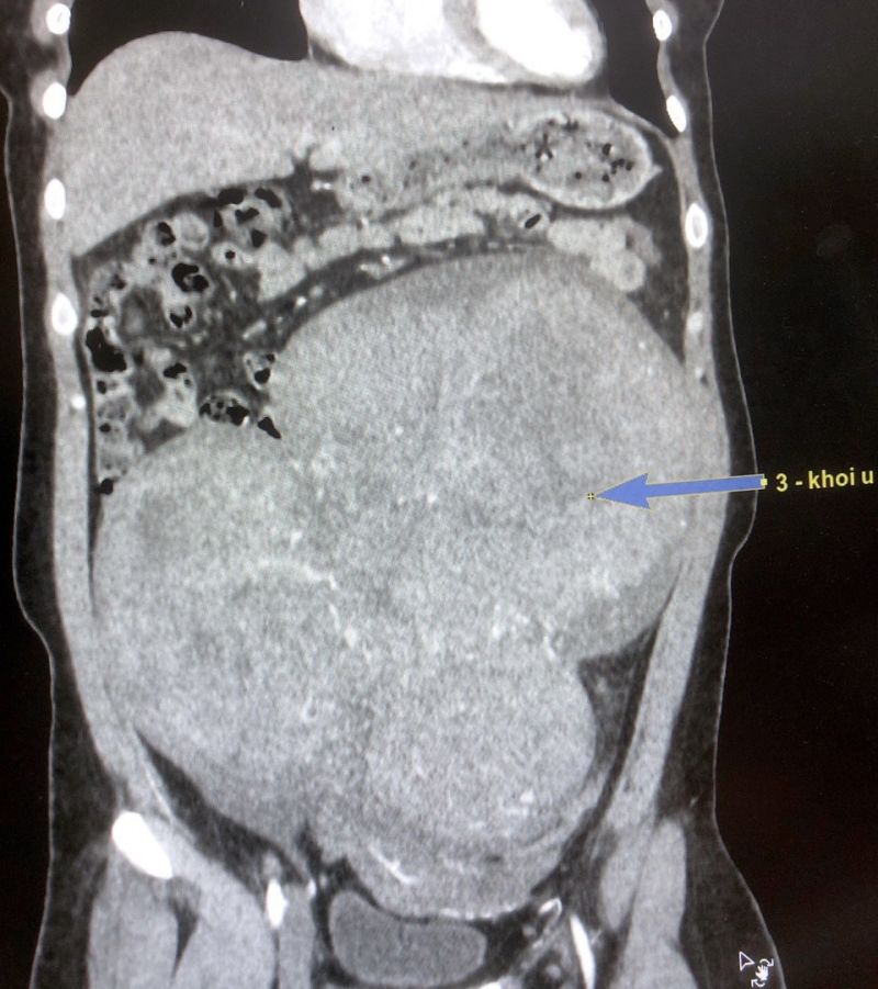 Phẫu thuật thành công bệnh nhân có khối u tử cung nặng 5,5kg