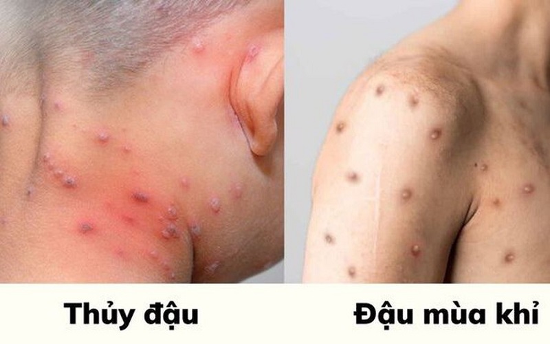 Hướng dẫn phân biệt bệnh đậu mùa khỉ và thủy đậu