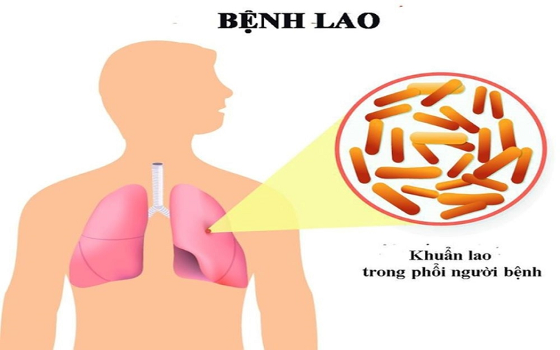 Công điện của Thủ tướng Chính phủ về tăng cường công tác phòng, chống bệnh Lao