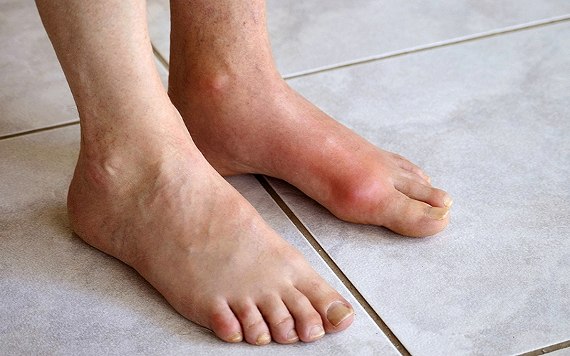 Bác sĩ của bạn: Không tự ý điều trị bệnh gout tại nhà