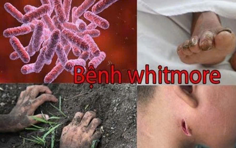 Những điều cần biết về bệnh Whitmore